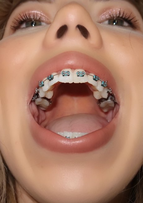 Kate in Braces sexy model pictures